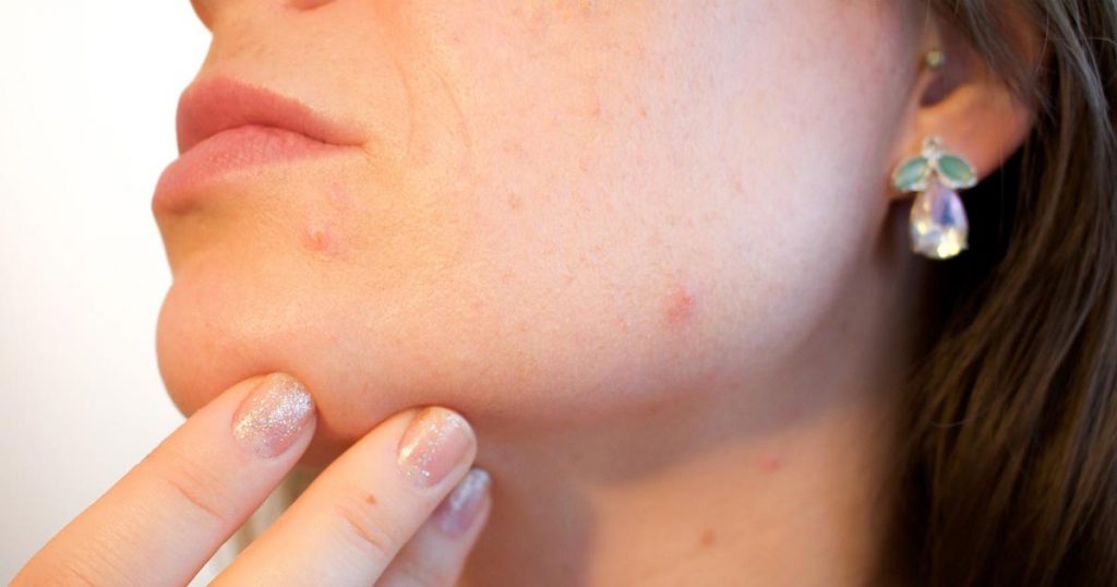 Acne on women face